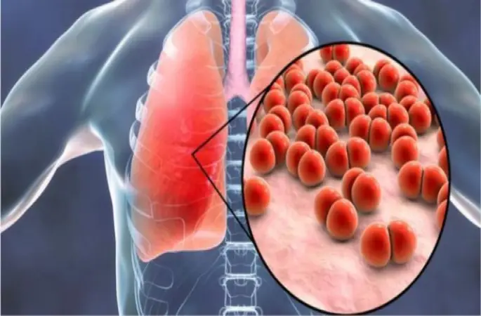 Zatürre Ciddi Bir Hastalıktır