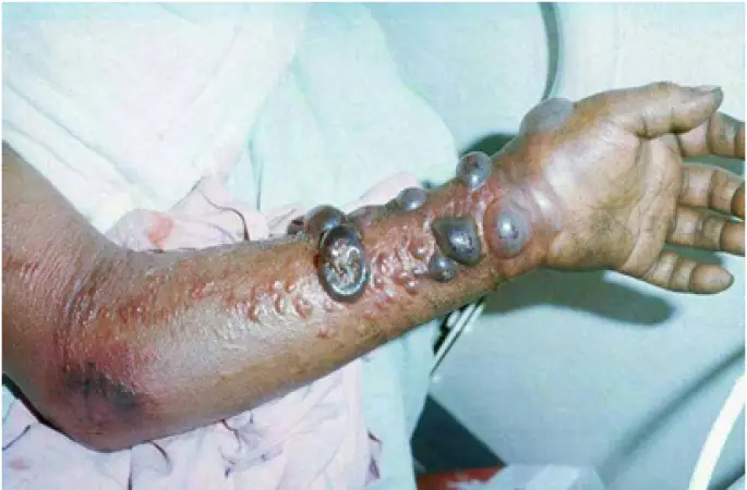 DİKKAT Ebola virüsünden korunmanda öncelik HİJYEN!!