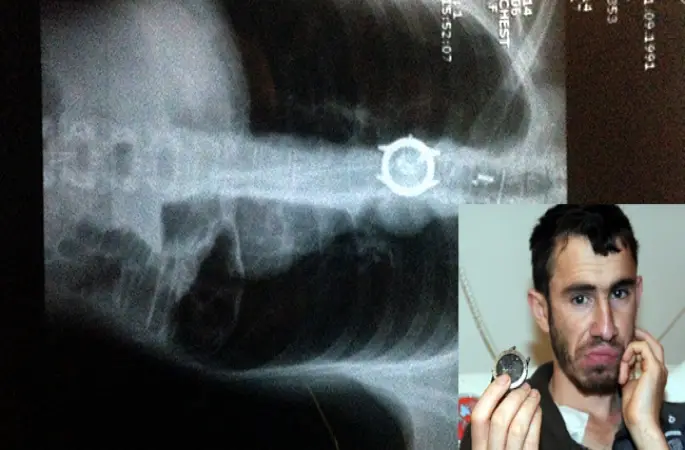 Boğazından saat çıktı