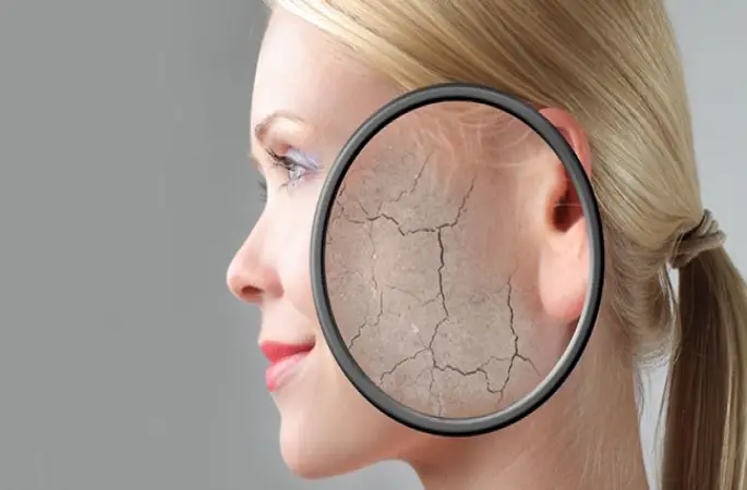 Kışın cilt kuruluğuna dikkat edilmeli